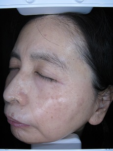 シミ F T様 55歳 マリーアンロイス肌再生症例 千葉県柏市の肌再生専門店マリーアンロイス